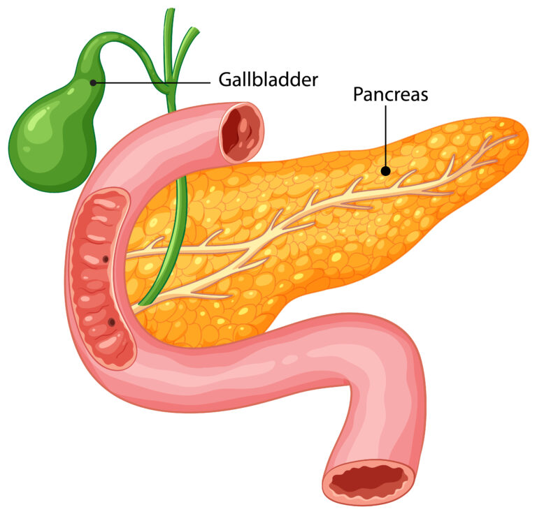 Post-Cholecystectomy Pain Management Diet